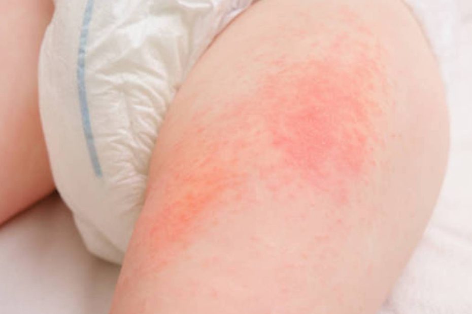 10 Natural Ways to Relieve Diaper Rash in Summer