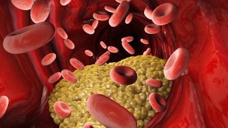 Cholesterol formation in an artery