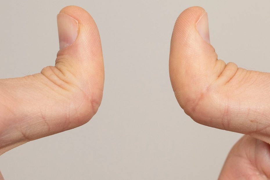 Why double-jointed people are more likely to have health problems