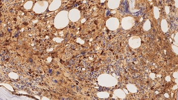 A bone marrow biopsy showing dense expression of galectin-1 in myelofibrosis. The image was captured by the researchers / Credit: Professor Daniel Royston, University of Oxford.